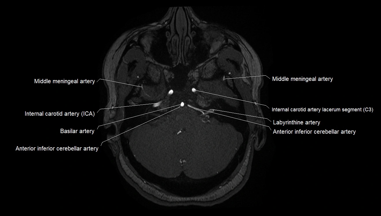 MRA brain (cerebral arteries) anatomy axial 3T image 2.webp